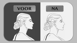 voor en na een cosmetische correctie